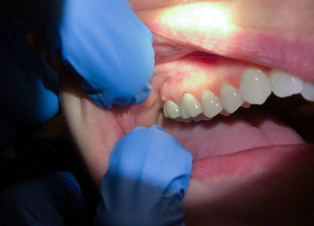 Best Broken or Chipped Tooth Repair in Chattahoochee Hills, GA